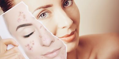 A girl holding an image of herself with so many pimples