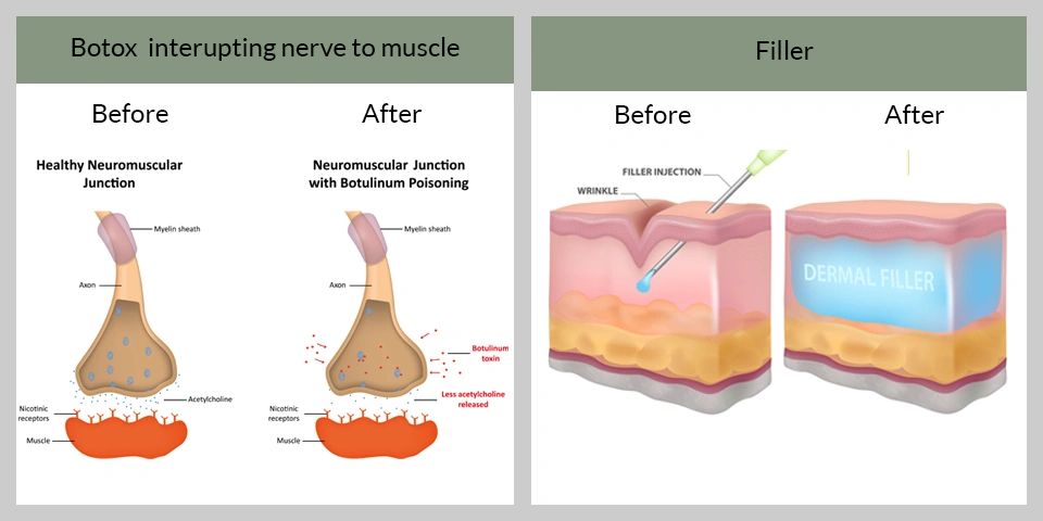 How Botox and Filler work differently