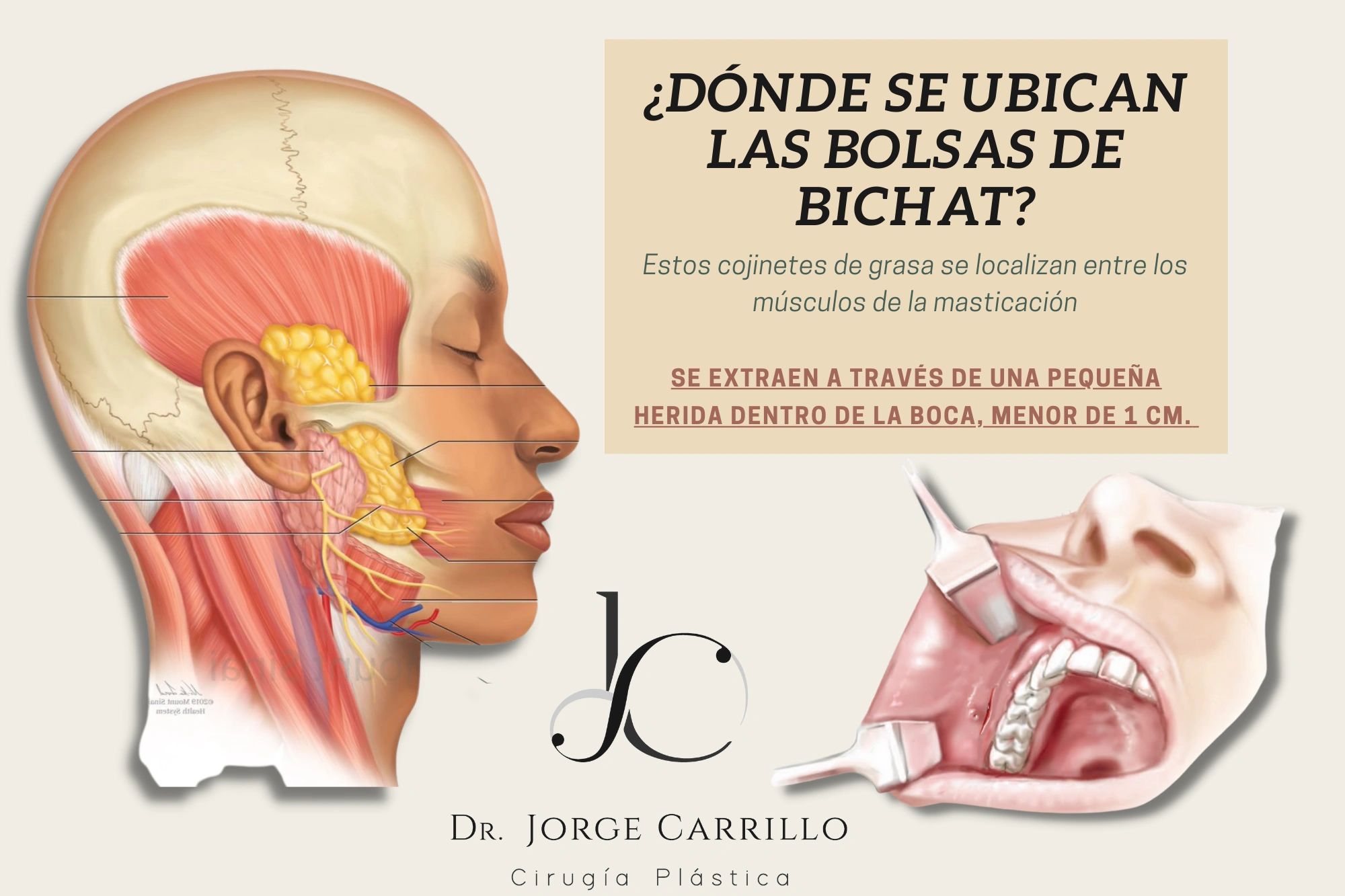 La bichectomía (extracción de bolsas de bichat) adelgaza la cara. Lo hace un cirujano plástico.