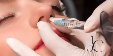 Mejorando la forma de la nariz con una rinomodelación con ácido hialurónico.