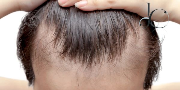 La alopecia es la caída del pelo, minoxidil, micropunciones y las mejores tecnicas a tu alcance. 