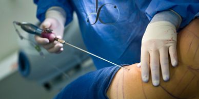 Paciente sometido a cirugía plástica para realizarse una liposucción. Es una cirugía plástica.