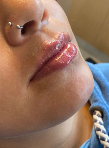 Resultado inmediato después de la aplicación de ácido hialurónico en labios.