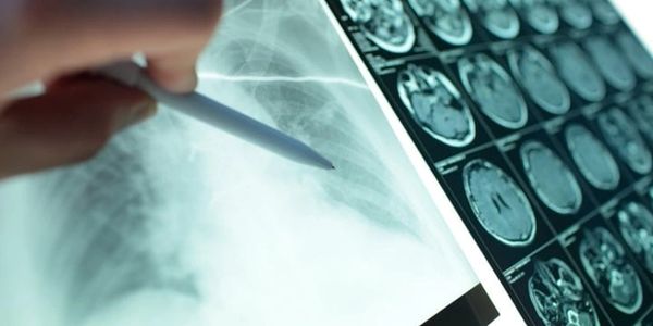 Doctor points with pen to an X-ray image of lungs hanging on a negatoscope and mri image of the head