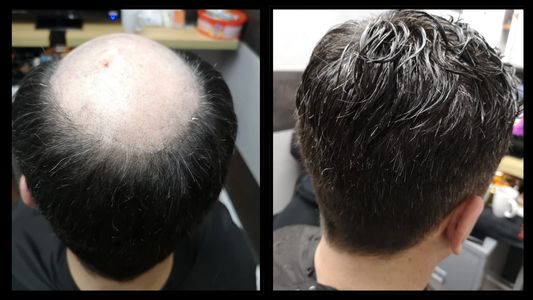 Before and after picture of a man with hair loss having a male hair replacement at New U Hair Salon n