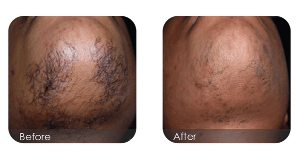 Before and after chin laser hair removal for dark skin, PCOS facial hair managed, Nanaimo clinic.