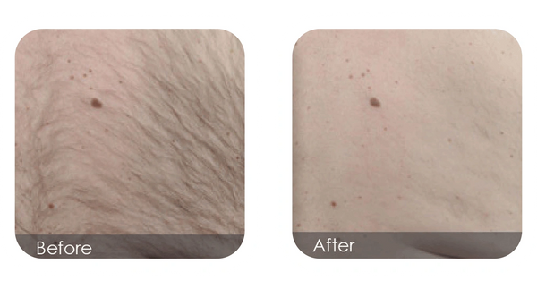 Unwanted chest hair on men/women removed with laser at Supernatural Esthetics Nanaimo.