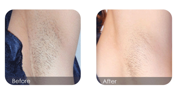 Underarm, bikini laser hair removal prevents shaving rash, ingrowns; lasting results, Nanaimo