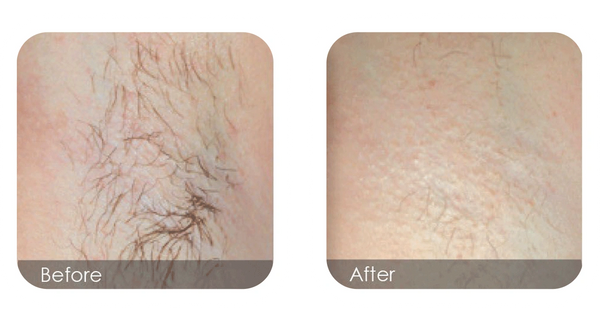 Unwanted body hair like underarms, stomach removed with laser at Supernatural Esthetics Nanaimo.