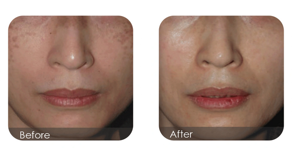 Before + after 2D laser facial, hyperpigmentation cleared for even skin tone, Nanaimo clinic.