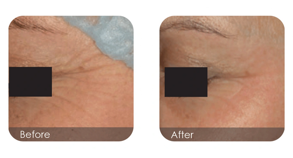 Before and after 5D laser facial — crow’s feet reduced for smoother, youthful eyes, lasting results,
