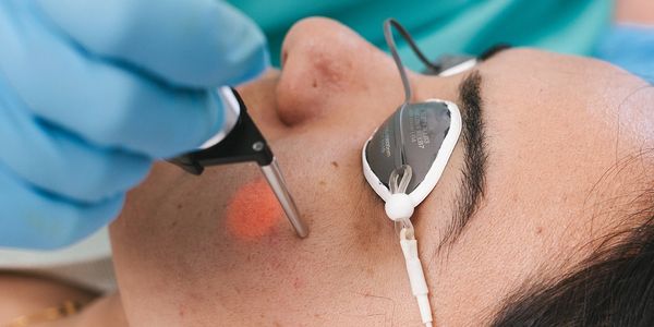 Close-up of laser targeting deep skin layers to boost collagen for smoother, tighter, youthful face.
