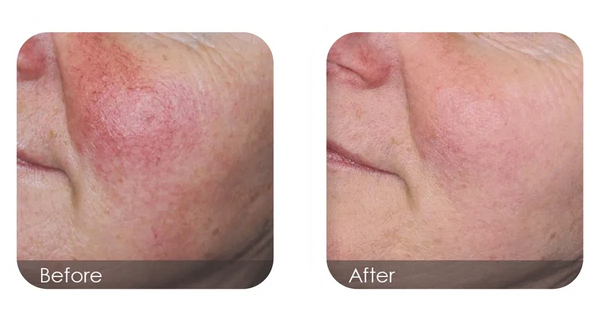 Roseacea removed in 1-2 sessions of bespoke laser treatments at Supernatural Esthetics