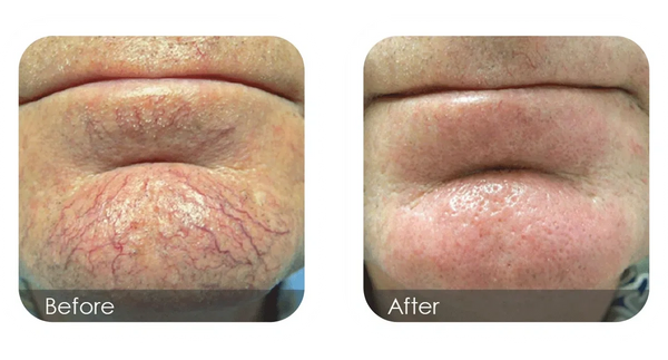 Large broken capillaries/spider veins on face removed with bespoke laser facials at Supernatural.