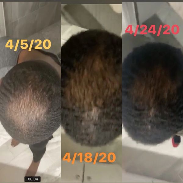 Hair growth results