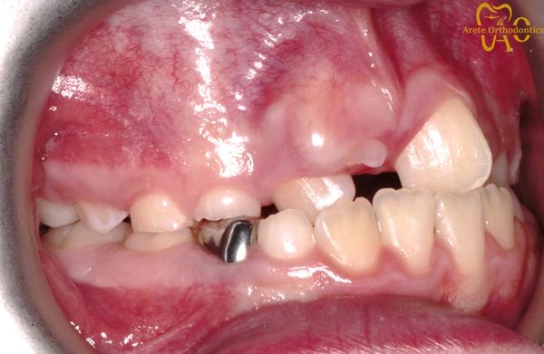 Crooked teeth, crossbite, delayed eruption of adult tooth