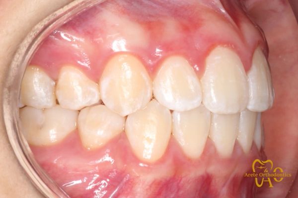 straight teeth