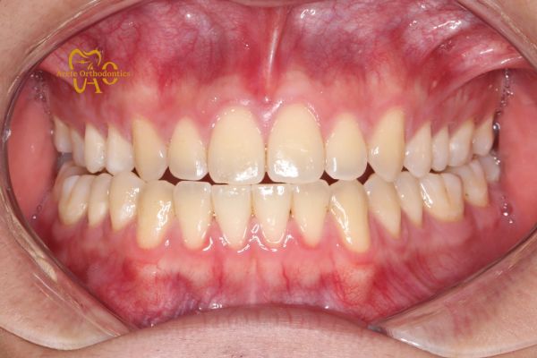 Class III, underbite, crossbite