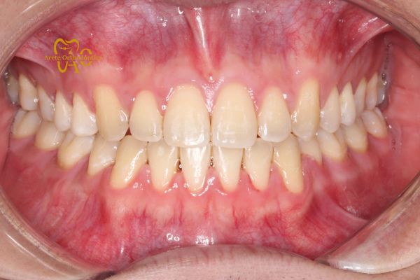 Straight teeth
