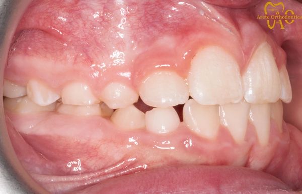 Early interceptive treatment in child to correct anterior crossbite and delayed eruption of tooth