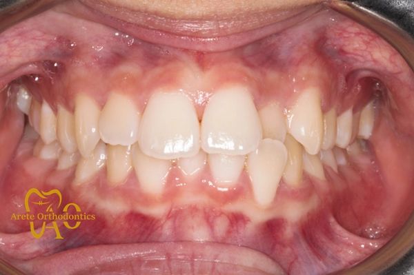 Teenager with crooked teeth and crossbite