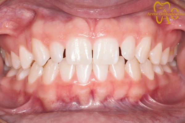 Teenager with spacing and gaps between teeth, rotated tooth, crooked teeth, small teeth