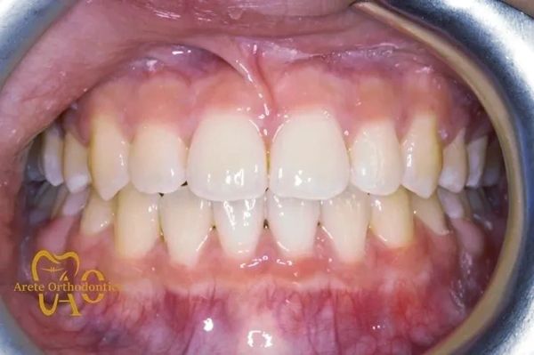 Teenager after braces to straighten teeth and correct crossbite