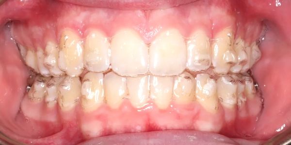 Invisalign, attachments