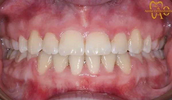 Adult after braces to correct deep bite and straighten teeth