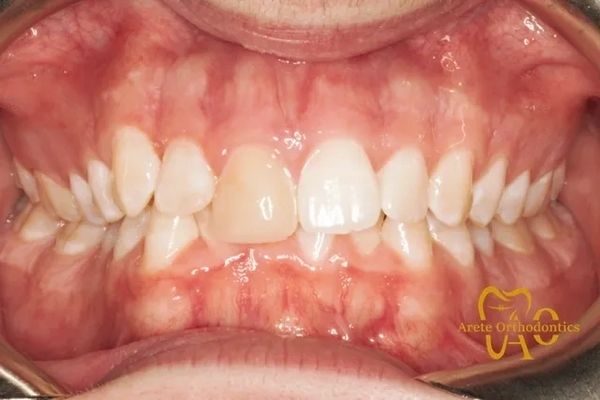 Adult, crooked teeth, slanted teeth, cant, dark tooth