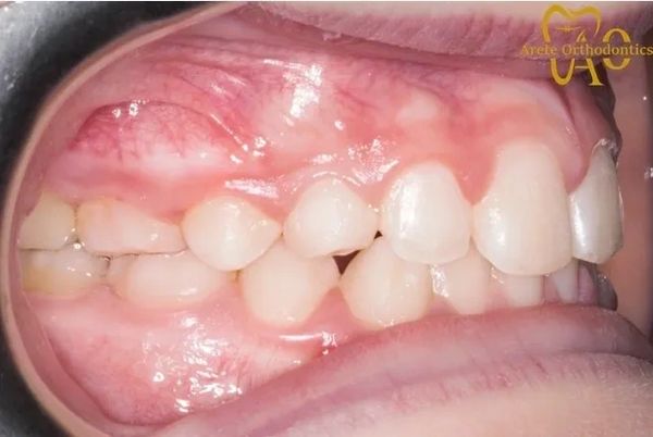 Early interceptive treatment for child with removable plate to correct crossbite