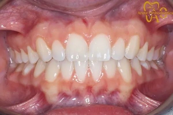 Teenager after Invisalign to straighten teeth and close gaps and spacing