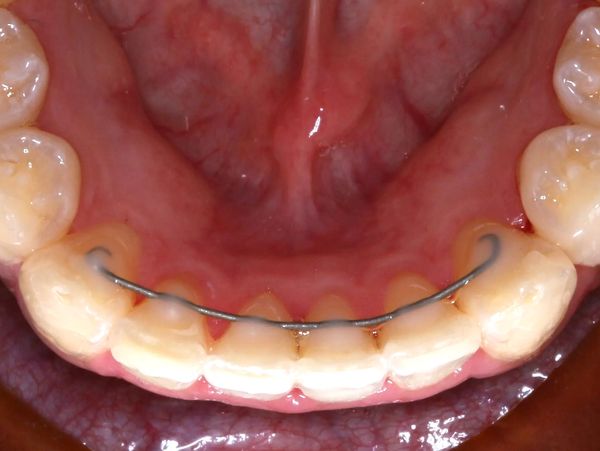 Permanent retainer