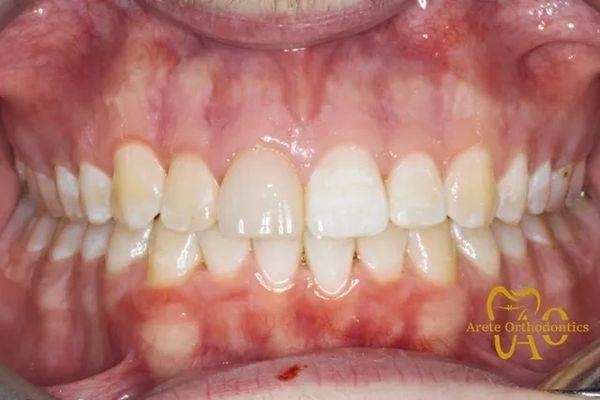Adult braces to straighten teeth and correct bite