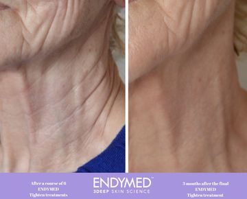 Endymed Tighten and contour