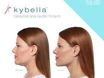 Before and after picture of kybella