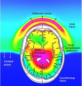 Blast impact on the brain.