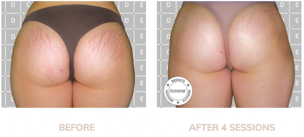 cellulite removal in Troy, MI
