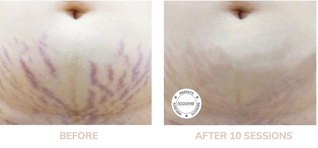 remove stretch marks in Troy, MI
