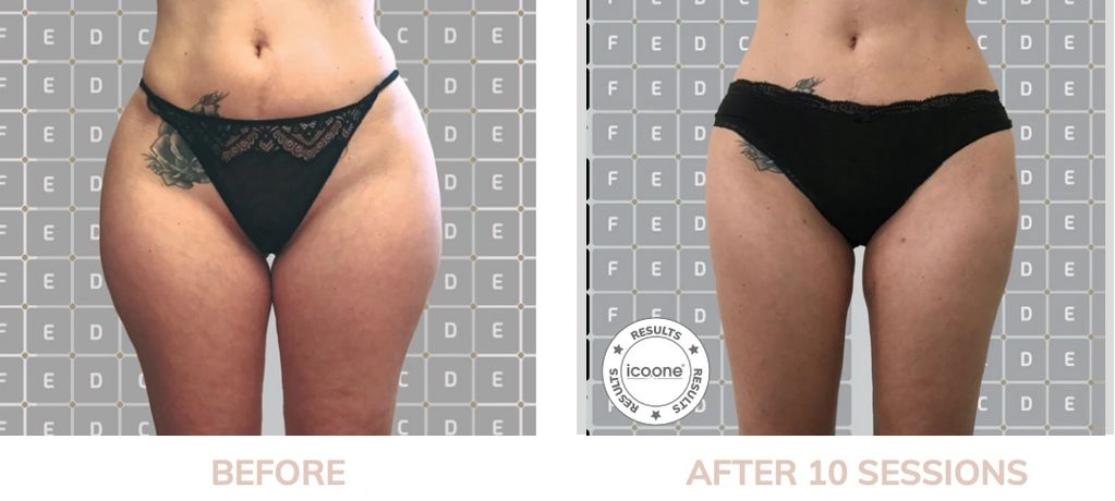 lose belly fat in Troy, MI