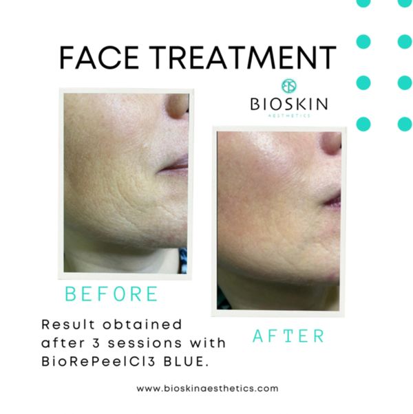face treatment. Before and After in Troy.