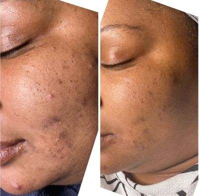 Face Treatment Before and After in Troy, MI