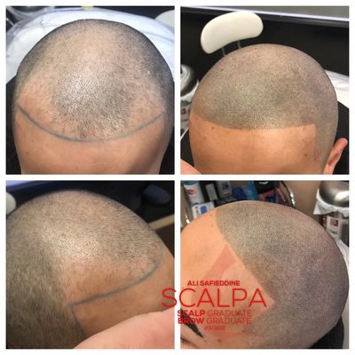 Scalp micro pigmentation, hairloss treatment, hair loss replacement service, SMP Artist 