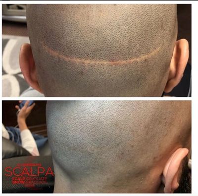 hair transplant, SMP scar treatment