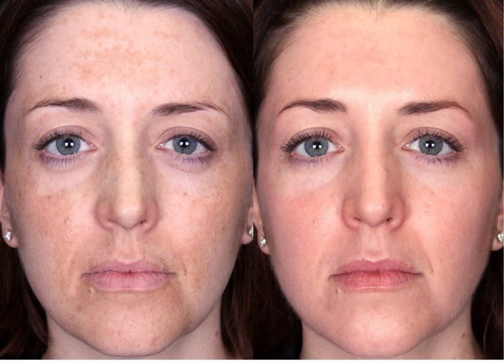Pro Power Peel before and after course of 3