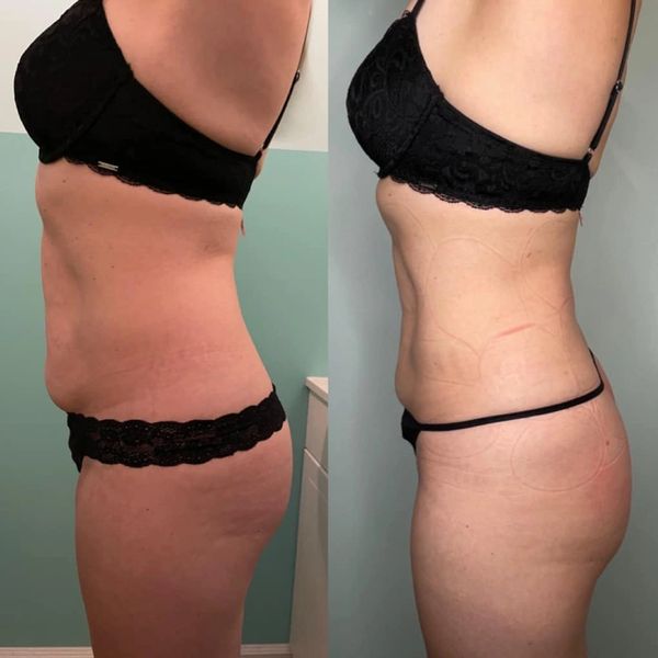 Side-by-side before and after photos showing body contouring results on a woman in black lingerie.