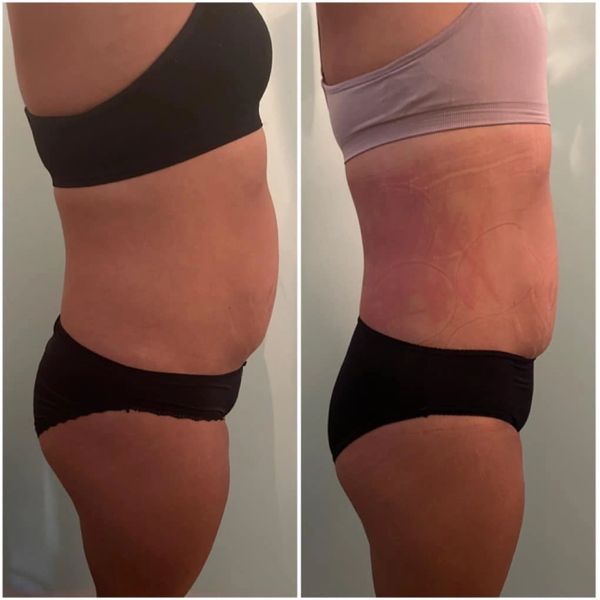 Side-by-side before and after images showing abdominal changes in a woman.