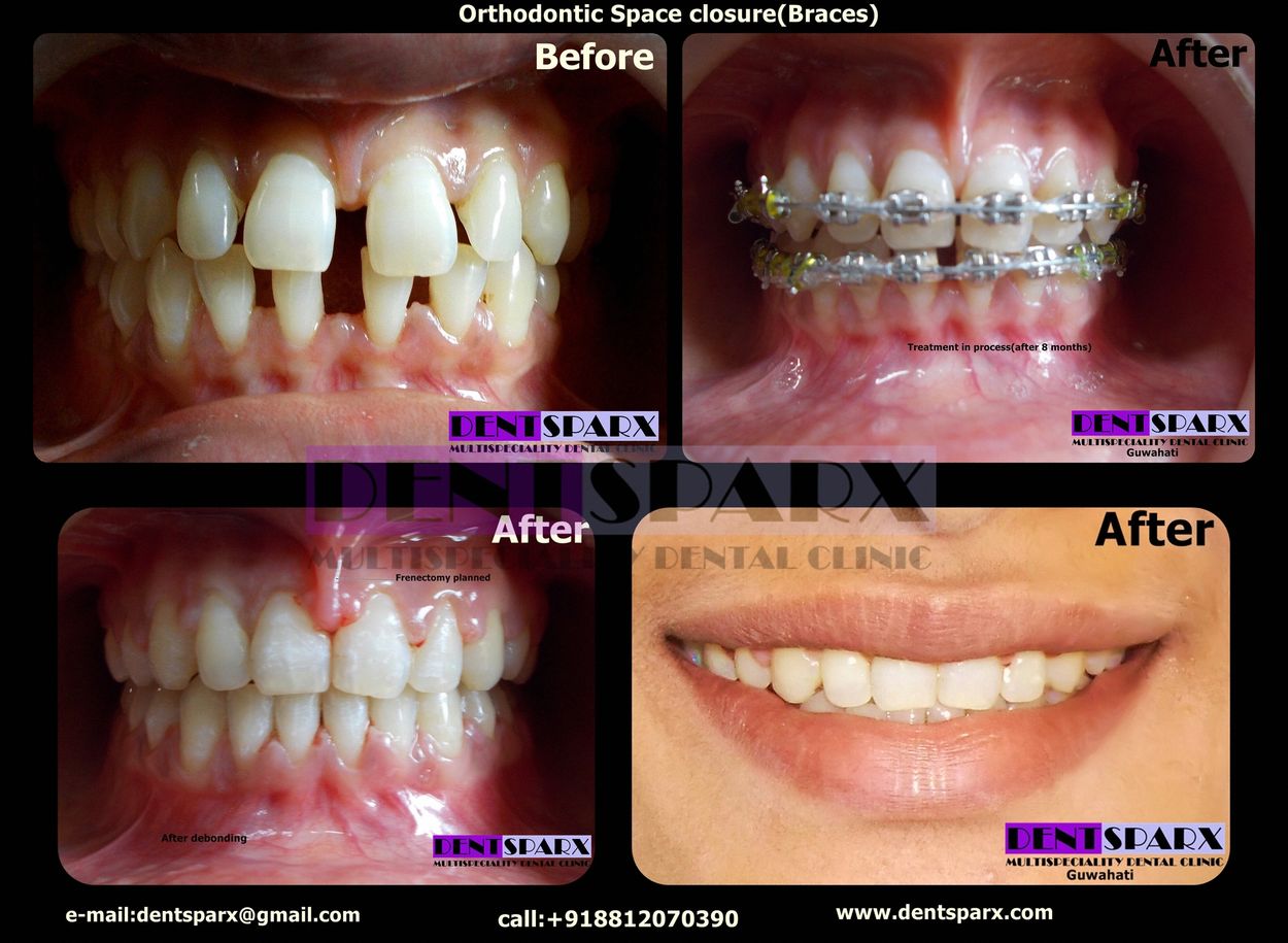 Orthodontic space closure /braces at Dentsparx Dental Clinic Guwahati