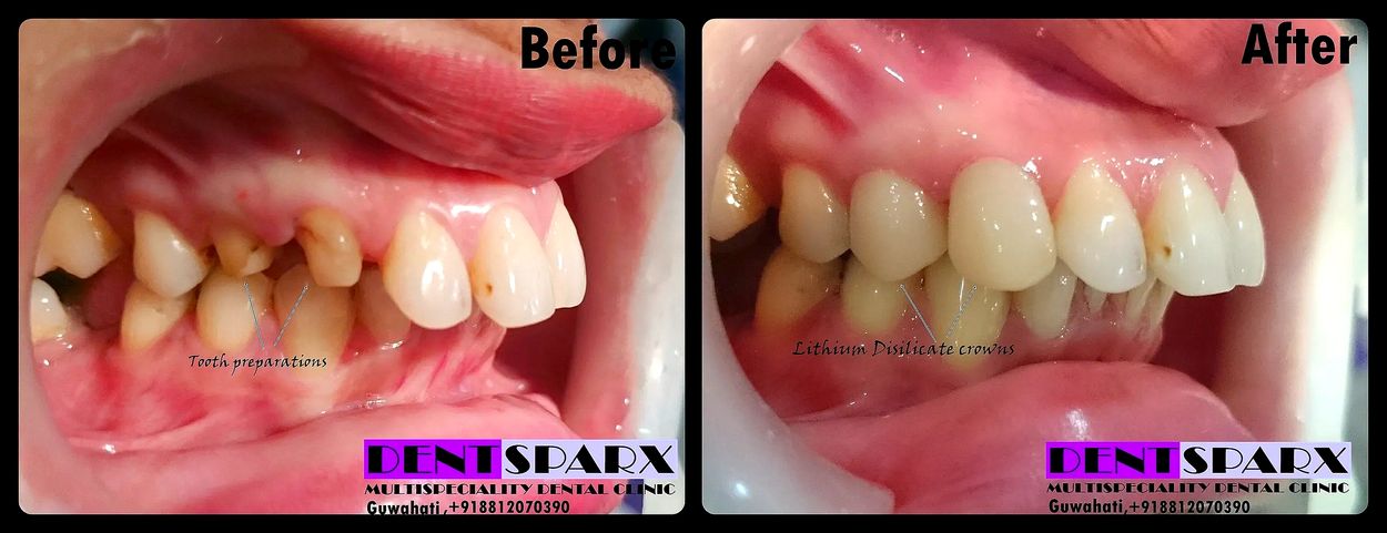 High aesthetic dental crowns fixed to restore  damaged teeth at Dentsparx dental clinic, Guwahati.
