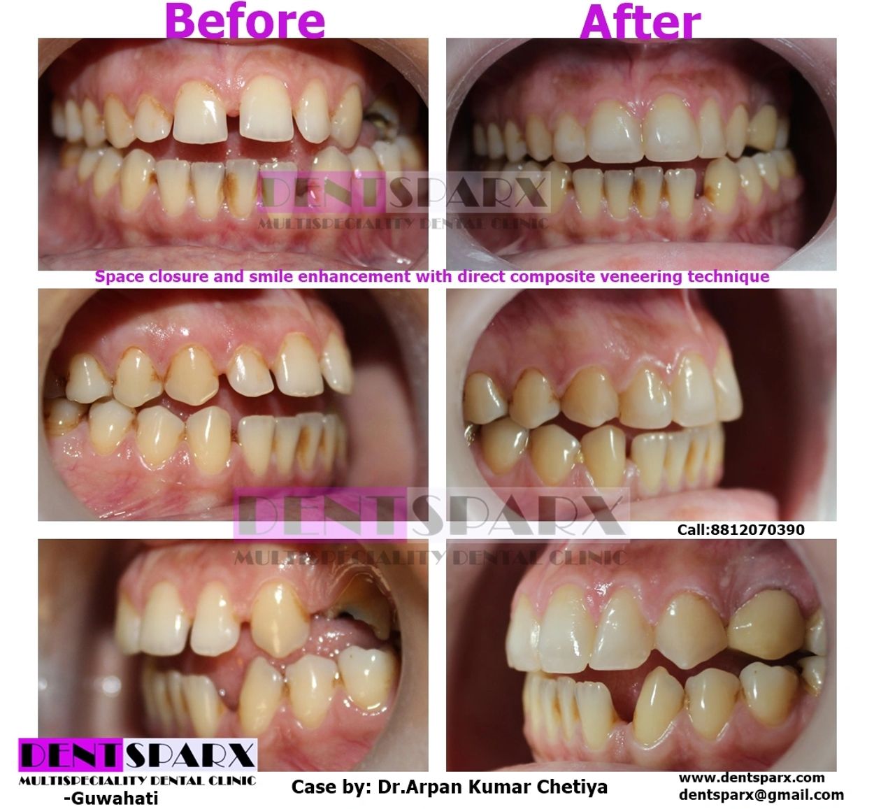 Teeth space closure in Guwahati by best cosmetic dentist in Guwahati Dr Arpan Kumar Chetiya 